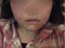 骨切り（あご） / 骨削り（エラ） / 骨削り（頬） id（アイディ）美容外科 DAY 1 サムネイル用