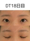 二重埋没 けやき美容クリニック 沼津院 DAY 18 サムネイル用