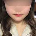 骨切り（あご） / 骨削り（エラ） / 骨削り（頬） id（アイディ）美容外科 AFTER サムネイル用