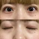 二重切開 松下皮フ形成外科 DAY 38 サムネイル用