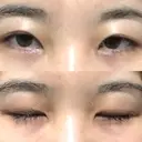 二重切開 / 眼瞼下垂（切開） ブリスクリニック形成外科・美容外科・美容皮膚科 福岡 DAY 204 サムネイル用