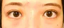 眉下切開 Taide Suenaga Clinic（タイデスエナガクリニック） DAY 239 サムネイル用