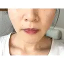 バッカルファット除去 / 脂肪吸引（顔） EMMA CLINIC（エマクリニック） DAY 31 サムネイル用