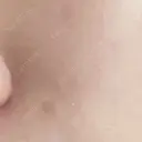 ほくろ・いぼ切除（肌） 大山皮膚科 AFTER サムネイル用
