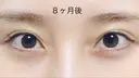 二重切開 / 上まぶたたるみ取り R.O.clinic DAY 243 サムネイル用
