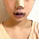小鼻縮小（切開） / 口唇縮小術 / 口角挙上 / その他（鼻） / その他（口元） B-LINE CLINIC 池袋院 DAY 0 サムネイル用