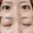 二重切開 松下皮フ形成外科 DAY 45 サムネイル用