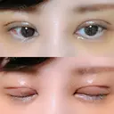 二重切開 / 目頭切開 / ヒアルロン酸注入（涙袋） FROM B整形外科 (旧バウム整形外科) DAY 5 サムネイル用