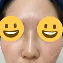 隆鼻術 サラ美容外科 DAY 5 サムネイル用