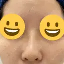 隆鼻術 サラ美容外科 DAY 6 サムネイル用