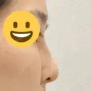 隆鼻術 サラ美容外科 DAY 6 サムネイル用