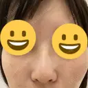 隆鼻術 サラ美容外科 DAY 7 サムネイル用