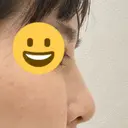 隆鼻術 サラ美容外科 DAY 7 サムネイル用