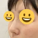 隆鼻術 サラ美容外科 DAY 7 サムネイル用