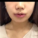 小鼻縮小（切開） / 口唇縮小術 / 口角挙上 / その他（鼻） / その他（口元） B-LINE CLINIC 池袋院 DAY 6 サムネイル用