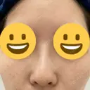 隆鼻術 サラ美容外科 AFTER サムネイル用