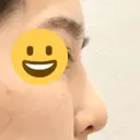 隆鼻術 サラ美容外科 DAY 14 サムネイル用