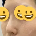 隆鼻術 サラ美容外科 DAY 14 サムネイル用