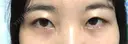 二重切開 / 眼瞼下垂（切開） ブリスクリニック形成外科・美容外科・美容皮膚科 福岡 DAY 227 サムネイル用
