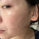 ルメッカ La Clinique Shinjuku 【ラクリニック 新宿】 DAY 5 サムネイル用