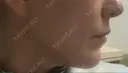 輪郭修正 / ボトックス（あご） / 脂肪溶解注射（顔） / ハイフ（顔） クリニックA.O. DAY 13 サムネイル用
