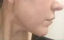 輪郭修正 / ボトックス（あご） / 脂肪溶解注射（顔） / ハイフ（顔） クリニックA.O. AFTER サムネイル用