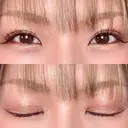 二重埋没 / 自然癒着法 シンデレラ＆ダヴィンチクリニック DAY 155 サムネイル用