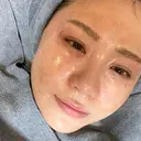 水光注射（ハリ・美肌） 表参道ウィズ・クリニック DAY 0 サムネイル用