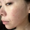 ルメッカ La Clinique Shinjuku 【ラクリニック 新宿】 DAY 8 サムネイル用