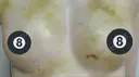 脂肪吸引（脚） / 脂肪吸引（お腹） / 豊胸（脂肪注入） 銀座マイアミ美容外科 DAY 14 サムネイル用