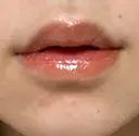 口唇縮小術 B-LINE CLINIC 池袋院 DAY 59 サムネイル用