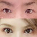二重切開 / 目頭切開 城本クリニック 豊橋院 AFTER サムネイル用