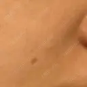 ほくろ・いぼ切除（肌） 川崎中央クリニック DAY 30 サムネイル用