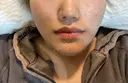 鼻尖形成（切開） / 軟骨移植 あつぎ美容クリニック DAY 23 サムネイル用