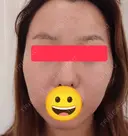 毛穴洗浄（ハイドラフェイシャルなど） / ヴェルヴェットスキン 藤ナチュレスキンクリニック AFTER サムネイル用