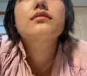 鼻尖形成（切開） / 軟骨移植 あつぎ美容クリニック DAY 25 サムネイル用