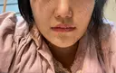 鼻尖形成（切開） / 軟骨移植 あつぎ美容クリニック DAY 25 サムネイル用