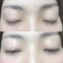 二重切開 松下皮フ形成外科 AFTER サムネイル用