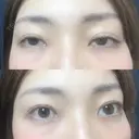 二重切開 松下皮フ形成外科 DAY 195 サムネイル用