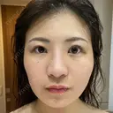 エレクトロポレーション / 毛穴洗浄（ハイドラフェイシャルなど） スキンシアクリニック AFTER サムネイル用