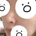 隆鼻術 / 鼻中隔延長（切開） / 小鼻縮小（切開） / 軟骨移植 / 鼻修正 / 鼻孔縁下降 FROM B整形外科 (旧バウム整形外科) DAY 28 サムネイル用