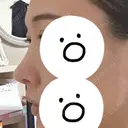 隆鼻術 / 鼻中隔延長（切開） / 小鼻縮小（切開） / 軟骨移植 / 鼻修正 / 鼻孔縁下降 FROM B整形外科 (旧バウム整形外科) DAY 28 サムネイル用