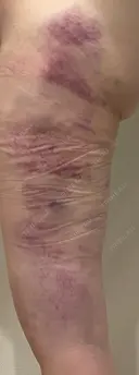 豊胸（脂肪注入） 銀座マイアミ美容外科 DAY 0 サムネイル用