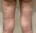 豊胸（脂肪注入） 銀座マイアミ美容外科 DAY 0 サムネイル用