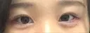 目尻切開 / タレ目形成・グラマラスライン（切開） / 目尻靭帯移動 アネシス美容クリニック AFTER サムネイル用