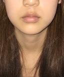 脂肪溶解注射（顔） 有楽町美容外科クリニック DAY 69 サムネイル用