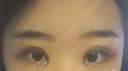 二重切開 / 目頭切開 / 眼瞼下垂（切開） / その他（目元） ブリスクリニック形成外科・美容外科・美容皮膚科 福岡 DAY 5 サムネイル用