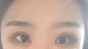 二重切開 / 目頭切開 / 眼瞼下垂（切開） / その他（目元） ブリスクリニック形成外科・美容外科・美容皮膚科 福岡 DAY 6 サムネイル用