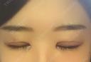 二重切開 / 目頭切開 / 眼瞼下垂（切開） / その他（目元） ブリスクリニック形成外科・美容外科・美容皮膚科 福岡 DAY 7 サムネイル用