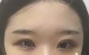 二重切開 / 目頭切開 / 眼瞼下垂（切開） / その他（目元） ブリスクリニック形成外科・美容外科・美容皮膚科 福岡 AFTER サムネイル用